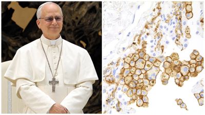 Pápež Lev má rakovinu, na ktorú každé štyri hodiny zomrie jeden Slovák. Príznaky sa podobajú prechladnutiu